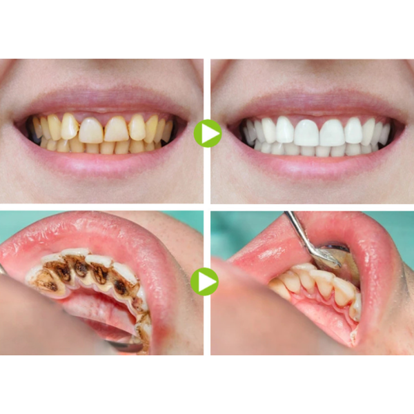 Разтвор за избелване на зъби HZS931 6