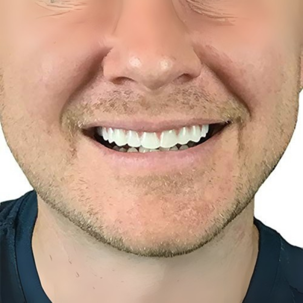 Instant Smile Lowers усмивка за минути TV1211-C 10 — 4sales Instant Smile Lowers усмивка за минути TV1211-C 10
