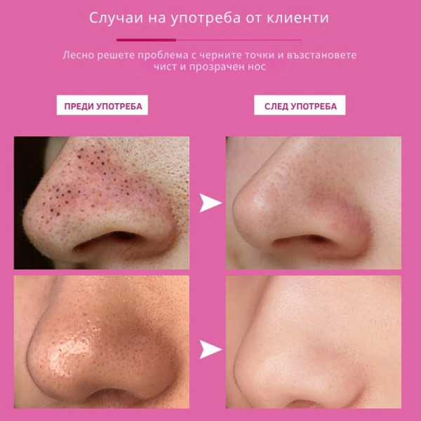 Ленти за премахване на черни точки Nose Mask - 10 броя