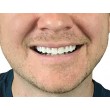 Instant Smile Lowers усмивка за минути TV1211-C 2