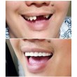 Instant Smile Lowers усмивка за минути TV1211-C 5
